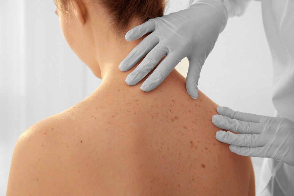 Skin Checkup: Diagnóstico De Cáncer De Piel Con Aplicación Ia Gratuita